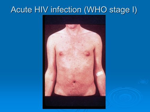 HIV infectie - Itg