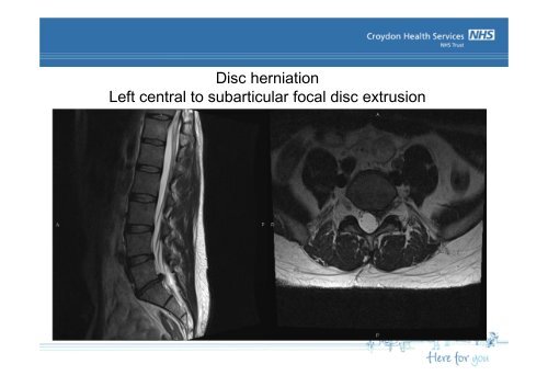 Imaging of the Spine - Croydon Health Services NHS Trust