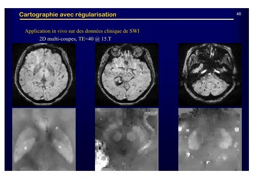 Imagerie Quantitative de la SusceptibilitÃ© par IRM : Un ... - IRCCyN