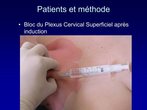 bloc du plexus cervical superficiel pour chirurgie thyroidienne - JLAR