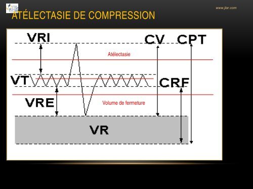 Indicateurs d'une bonne ventilation en anesthÃ©sie - JLAR