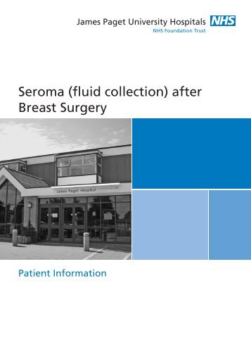 Seroma (fluid collection) after Breast Surgery - James Paget ...