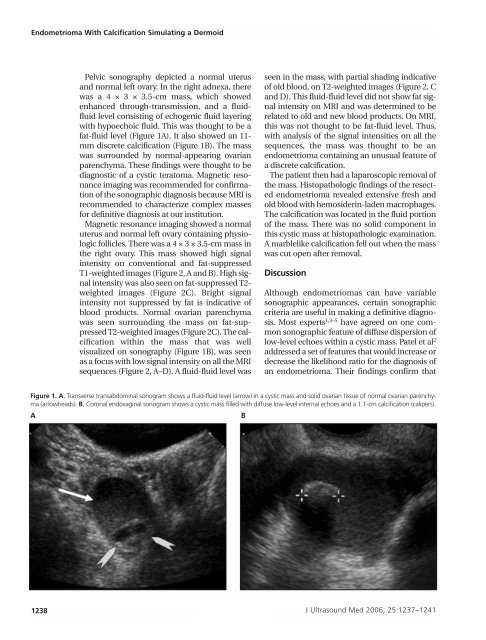 Endometrioma With Calcification Simulating a Dermoid - Journal of ...
