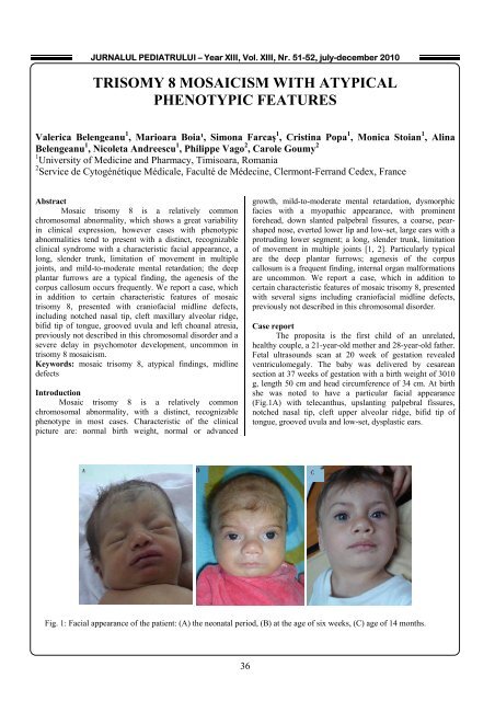 TRISOMY 8 MOSAICISM WITH ATYPICAL PHENOTYPIC FEATURES