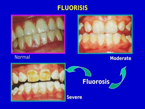 fluoride in dentistry - usm