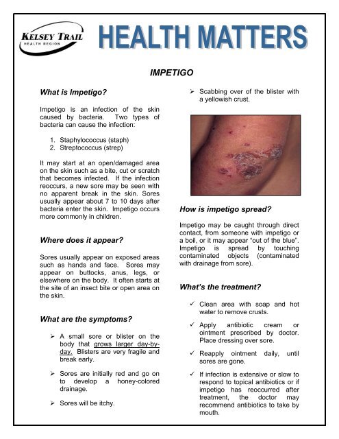 Impetigo - Kelsey Trail Health Region