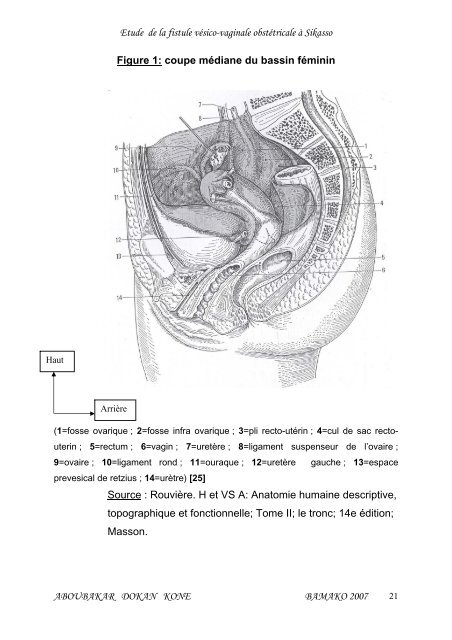 etude de la fistule vesico- vaginale obstetricale a sikasso