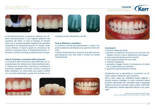 Guida Clinica alla Cementazione - Kerr