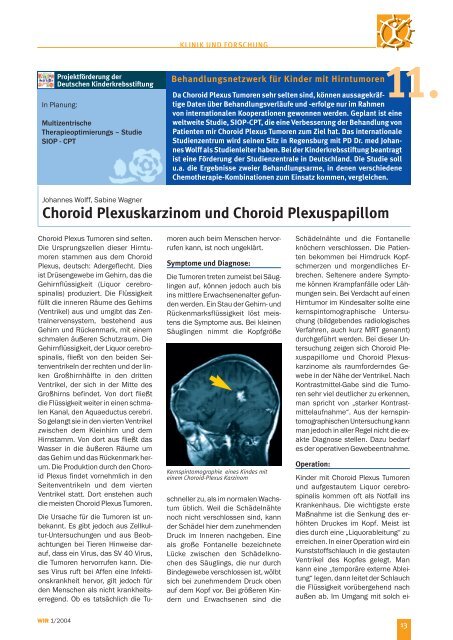 Choroid Plexuskarzinom und Choroid Plexuspapillom