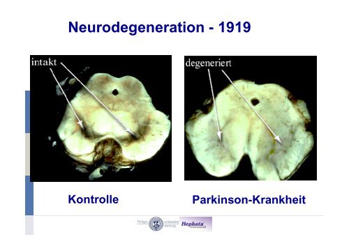 RBD-Studien und Meilensteine - Kompetenznetz Parkinson