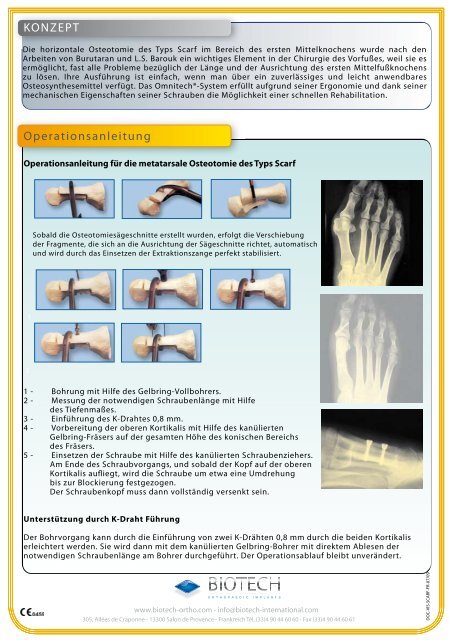 Operative Technik fÃ¼r die metatarsale Osteotomie ... - Biotech ortho