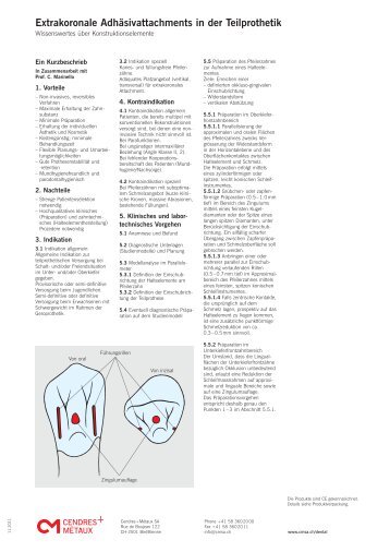 Extrakoronale Adhäsivattachments in der Teilprothetik - Cendres ...