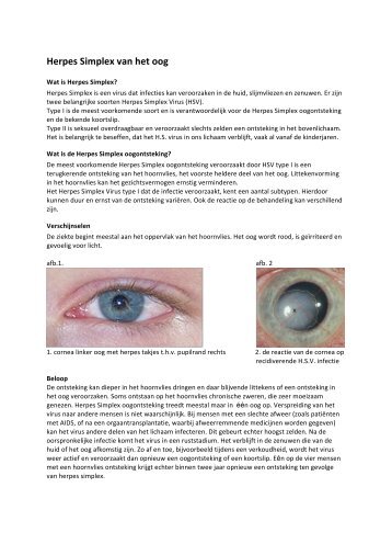 Herpes Simplex van het oog - Nederlands Oogheelkundig Gezelschap