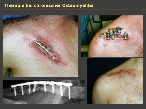 Dr. Matthias Buehler, postoperative Infektion - Septische Chirurgie