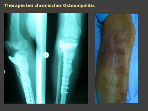 Dr. Matthias Buehler, postoperative Infektion - Septische Chirurgie