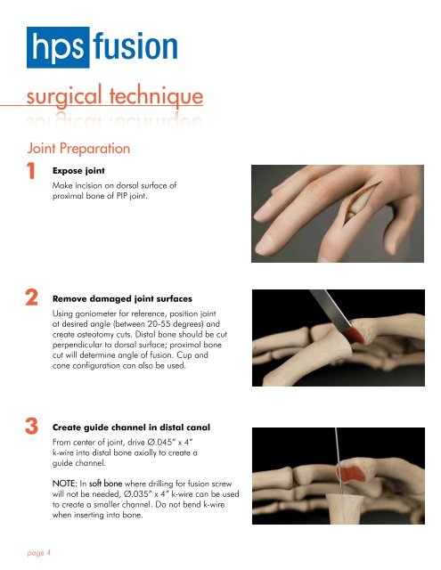 Surgical Guide - OsteoMed