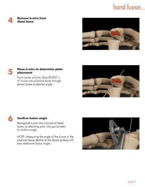 Surgical Guide - OsteoMed