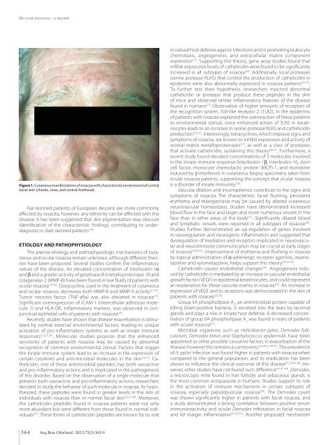 Ocular rosacea Crotoxin for paralysis of extraocular muscles ...