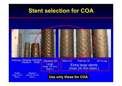 Stent Use in Coarctation of the Aorta - summitMD.com