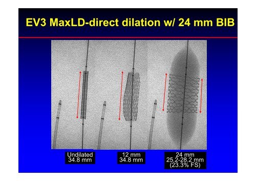 Stent Use in Coarctation of the Aorta - summitMD.com