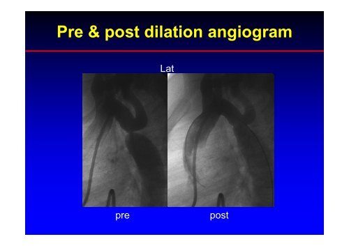 Stent Use in Coarctation of the Aorta - summitMD.com