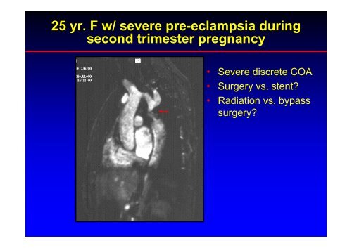 Stent Use in Coarctation of the Aorta - summitMD.com