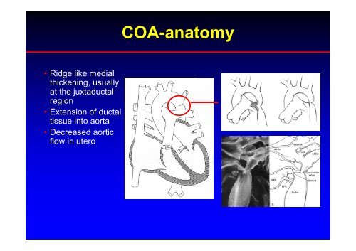 Stent Use in Coarctation of the Aorta - summitMD.com