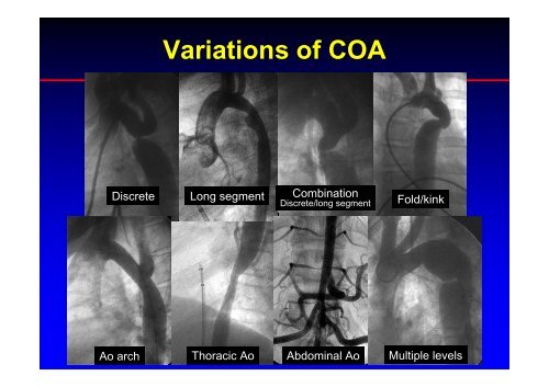 Stent Use in Coarctation of the Aorta - summitMD.com
