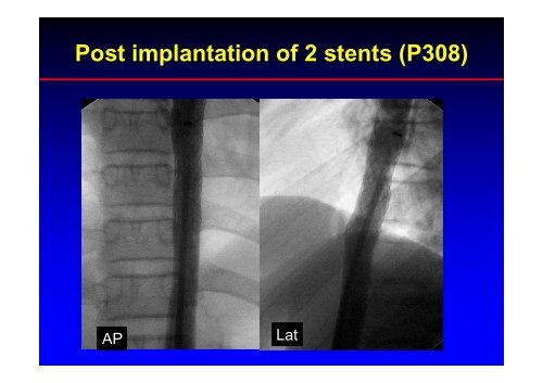 Stent Use in Coarctation of the Aorta - summitMD.com