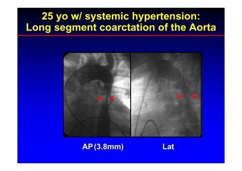 Stent Use in Coarctation of the Aorta - summitMD.com