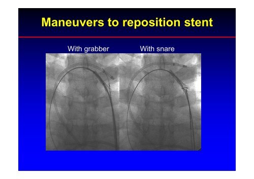 Stent Use in Coarctation of the Aorta - summitMD.com