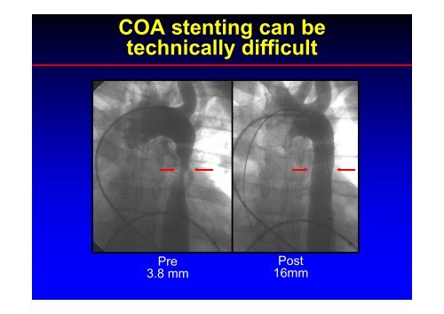 Stent Use in Coarctation of the Aorta - summitMD.com