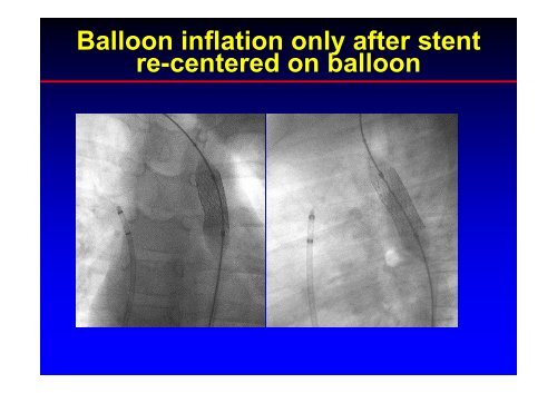 Stent Use in Coarctation of the Aorta - summitMD.com