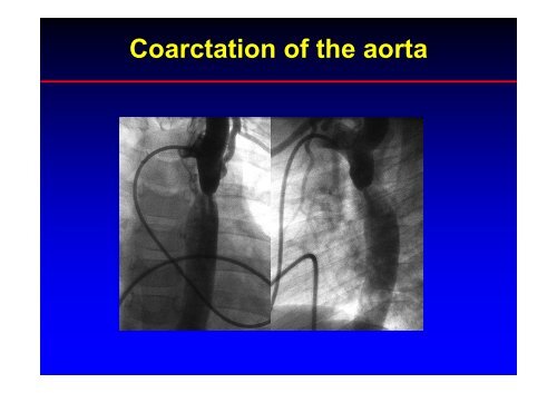 Stent Use in Coarctation of the Aorta - summitMD.com