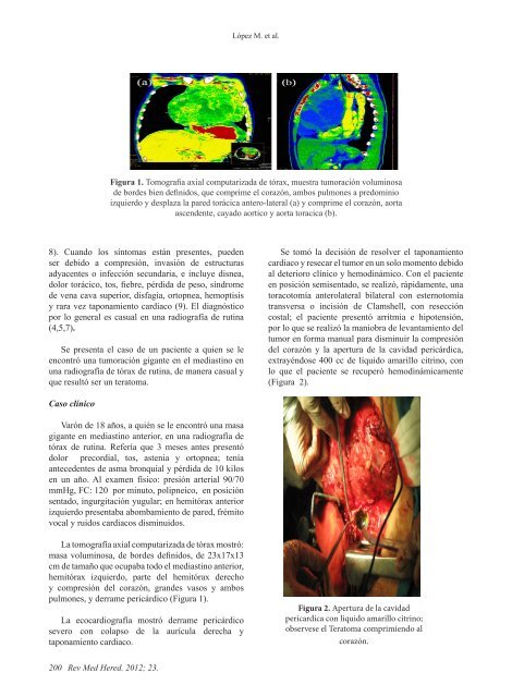 Teratoma gigante de mediastino anterior con ... - SciELO