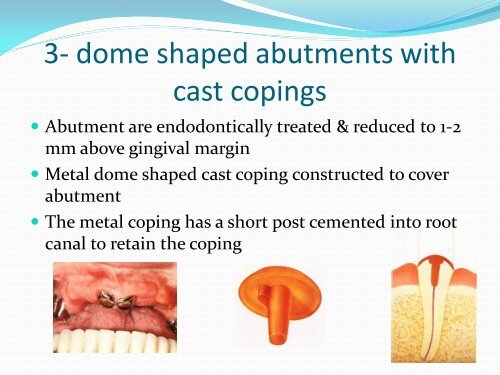 Types of tooth supported Over-dentures