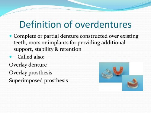 Types of tooth supported Over-dentures