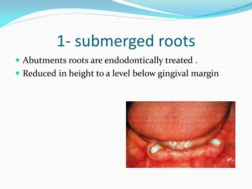 Types of tooth supported Over-dentures