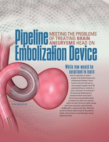 Pipeline Embolization Device - Mallinckrodt Institute of Radiology