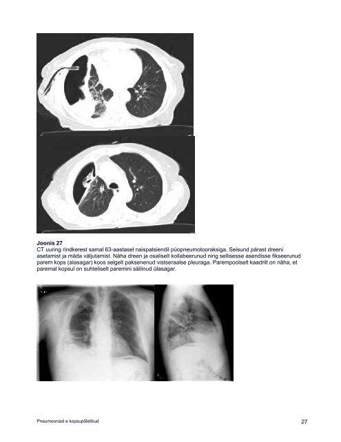Pneumoonia - Perearstikeskus.ee