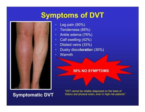 Deep Vein Thrombosis: Diagnosis & Treatment Reginald E. Smith ...