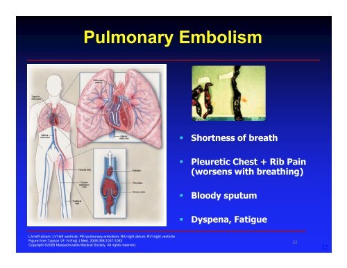 Deep Vein Thrombosis: Diagnosis & Treatment Reginald E. Smith ...