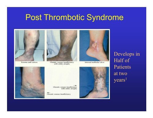 Deep Vein Thrombosis: Diagnosis & Treatment Reginald E. Smith ...