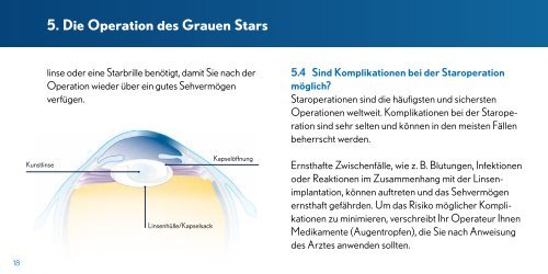 Der Graue Star(die Katarakt) - Bausch + Lomb