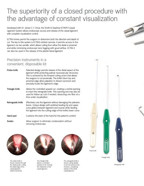 A breakthrough in carpal ligament release