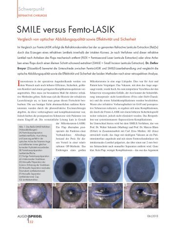 SMILE versus Femto-LASIK. Vergleich von ... - Premium Eyes