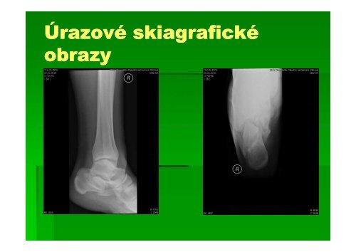 Zlomeniny patnÃ­ kosti - AKUTNE.CZ