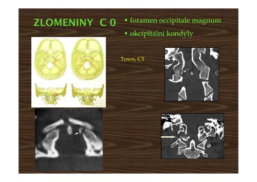 Trauma of the cervical spine - AKUTNE.CZ