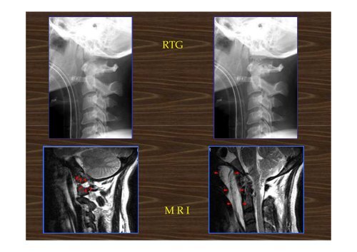 Trauma of the cervical spine - AKUTNE.CZ