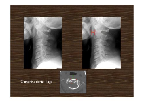 Trauma of the cervical spine - AKUTNE.CZ